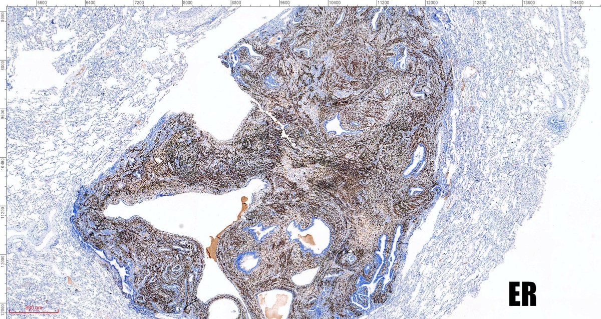 fabiotavora's tweet image. One of the most cryptic lesions for me in #pulmonarypath is the so called benign metastasizing leiomyoma. This case is a 37yo after myomectomy 3 years ago.