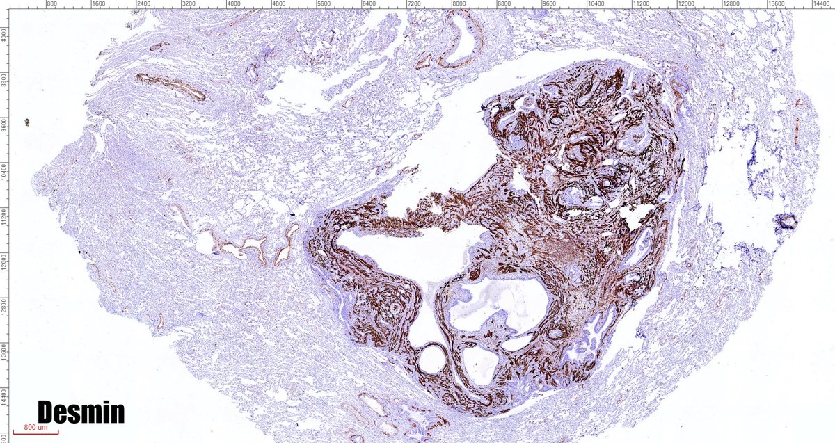 fabiotavora's tweet image. One of the most cryptic lesions for me in #pulmonarypath is the so called benign metastasizing leiomyoma. This case is a 37yo after myomectomy 3 years ago.