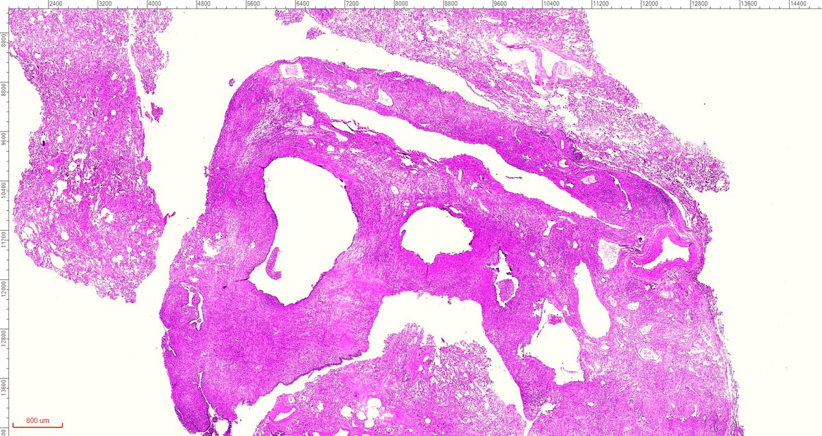 fabiotavora's tweet image. One of the most cryptic lesions for me in #pulmonarypath is the so called benign metastasizing leiomyoma. This case is a 37yo after myomectomy 3 years ago.
