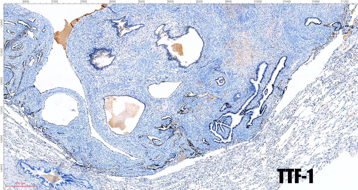 fabiotavora's tweet image. One of the most cryptic lesions for me in #pulmonarypath is the so called benign metastasizing leiomyoma. This case is a 37yo after myomectomy 3 years ago.