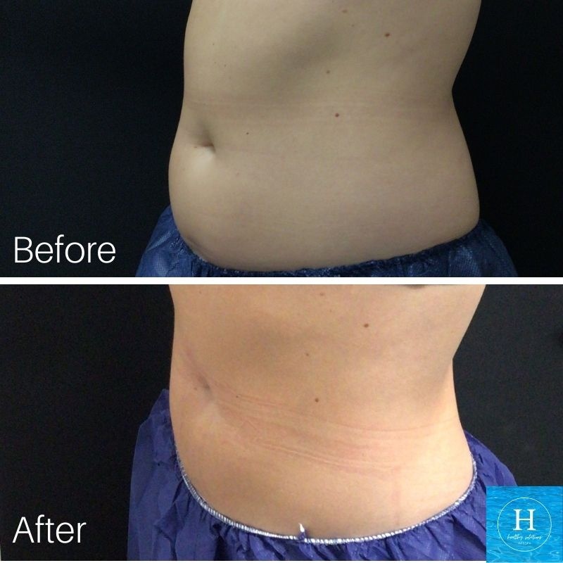 HlthySolMedSpa's tweet image. Dear Fat,
You are uninvited to holiday sinner.
- Coolsculpting