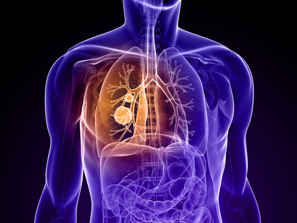 ChinMedJ's tweet photo. A new study in @ChinMedJ shows that #ThymosinAlpha1 as an adjuvant #immunomodulatory #therapy can improve outcomes for patients with non-small cell #LungCancer.
Read more here: https://t.co/4xqdVgeB7J
#NSCLC #Ta1 #Immunotherapy https://t.co/XQ6eIqPFI9