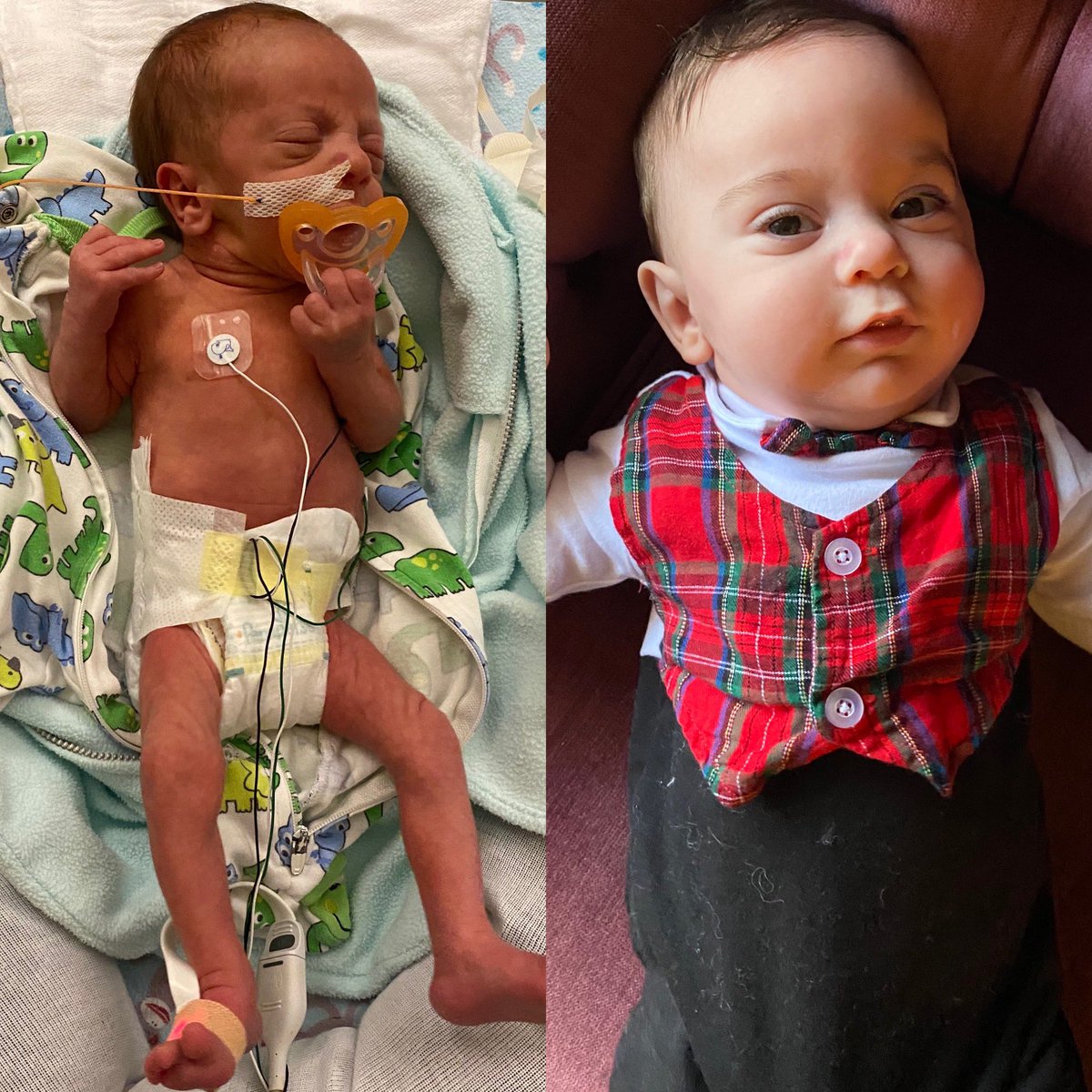 JuliaEColeman's tweet photo. Today is selective intrauterine growth restriction (#sIUGR) awareness day! In addition to TTTS Charles battled sIUGR, but by the grace of God protected his brain in utero. So proud of our little miracle who surpassed every doctor’s expectations! #gettingchubby #survivor https://t.co/XyNoJvRxOQ