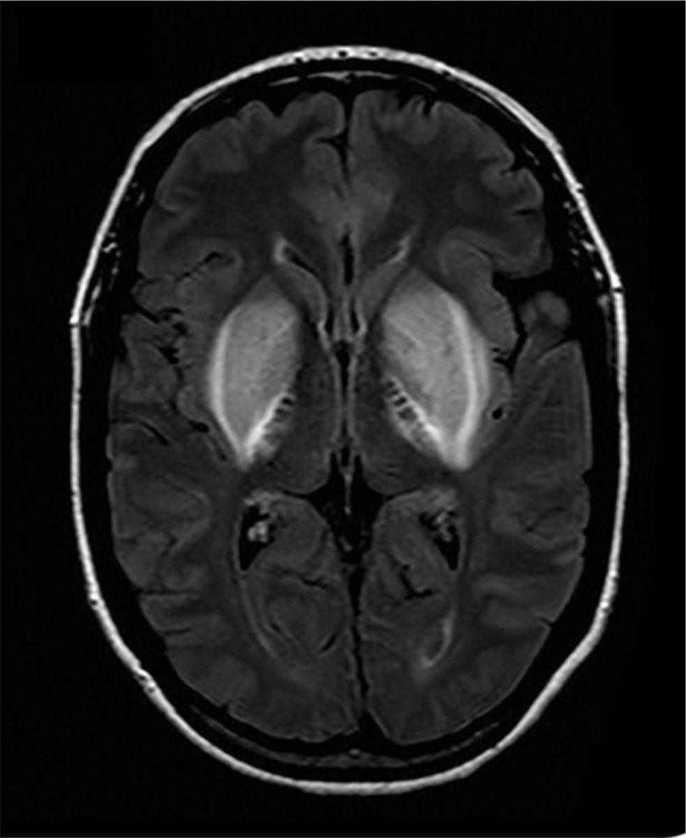 Kidney_Int's tweet photo. #KiReview: Uremic encephalopathy
https://t.co/MUfrHOJPYQ
@UVANeph @croncoIRRIV https://t.co/2SSEHXRwZl