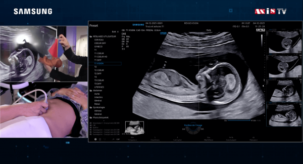 RevueVision's tweet photo. Trucs &amp; astuces pour le dépistage du 1er trimestre - Live scan sur patientes https://t.co/fjQUXM0qcE https://t.co/2xqONlRJjy