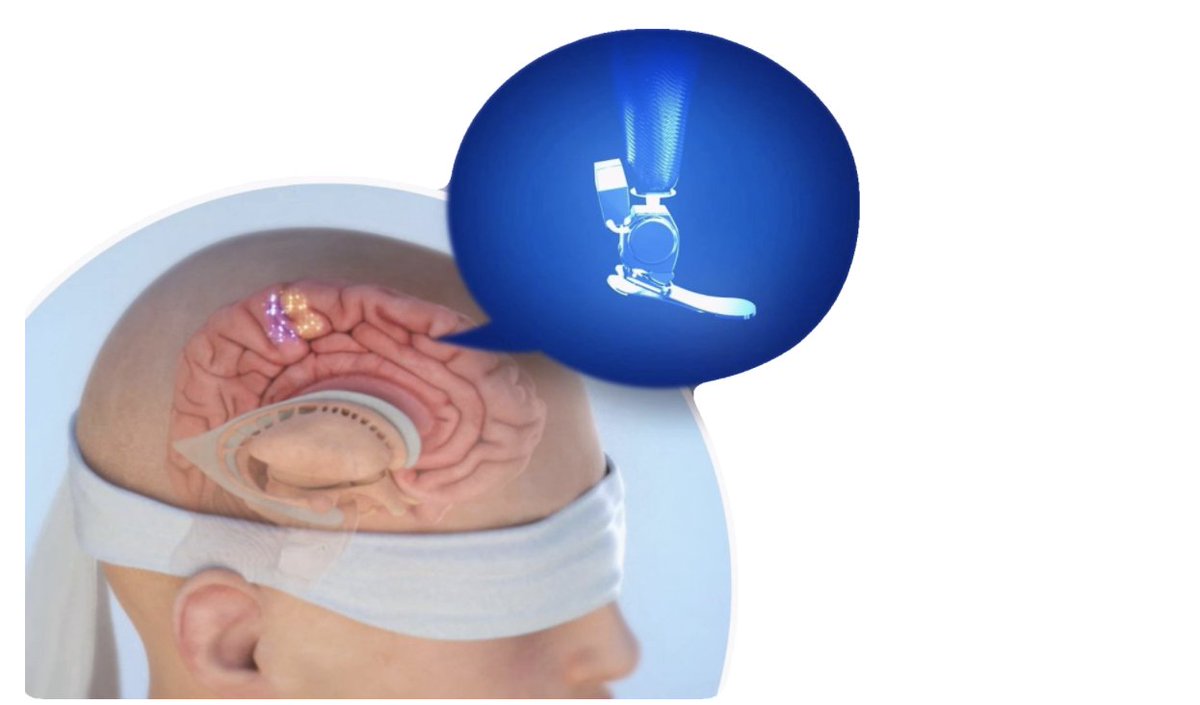 steppingstrong1's tweet photo. We talk a lot about the #EwingAmputation procedure at the #SteppingStrong Center, but what is the Agonist-Antagonist Myoneural Interface (#AMI) procedure?
Drs. Matthew Carty and Hugh Herr explain in this article.
https://t.co/732WiZoOHJ https://t.co/Sm1kOVZRB1