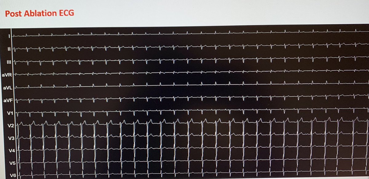 ChrisSpellmanEP's tweet photo. Another great case with @EOG_MD. Two PVC morphologies, LV summit and PM Pap muscle mapped with @BiosenseWebster #V7Prime and LAT-Hybrid. Stick to pull 1hr 35mins with a 30 min waiting period! @JACCJournals #Epeeps #AblateVt https://t.co/hRhuTyvjFx