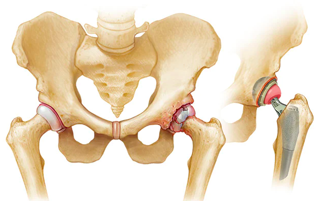 TroyMilesMD's tweet photo. A total hip arthroplasty is a hip replacement, which is the surgical removal of the damaged portion of the hip joint, replaced with a prosthesis. This procedure can restore the hip joint's integrity and  improve mobility.  #jointpain https://t.co/0JvWvJZTsv