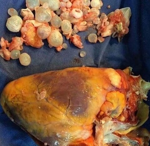 GYerathel's tweet photo. Very rare case of “Hydatid cyst” in the Heart caused by “Echinococcus granulosus” parasite. https://t.co/MO7PP5fYb7