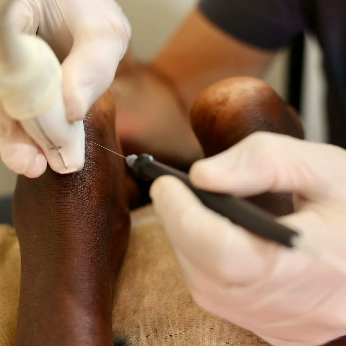 ionclinics's tweet photo. Proyectos solidarios @across_africa_ong ๐๐
#runnerforuganda beneficiados en la aplicaciรณn aguja bipolar #EPTEBipolarSystem, de mano de @jordireigfisio, agradecimiento por llevarnos tan lejos y reconocimiento de su labor en este proyecto.
Enhorabuena/gran trabajo ๐๐๐ https://t.co/kz36cCv7pE