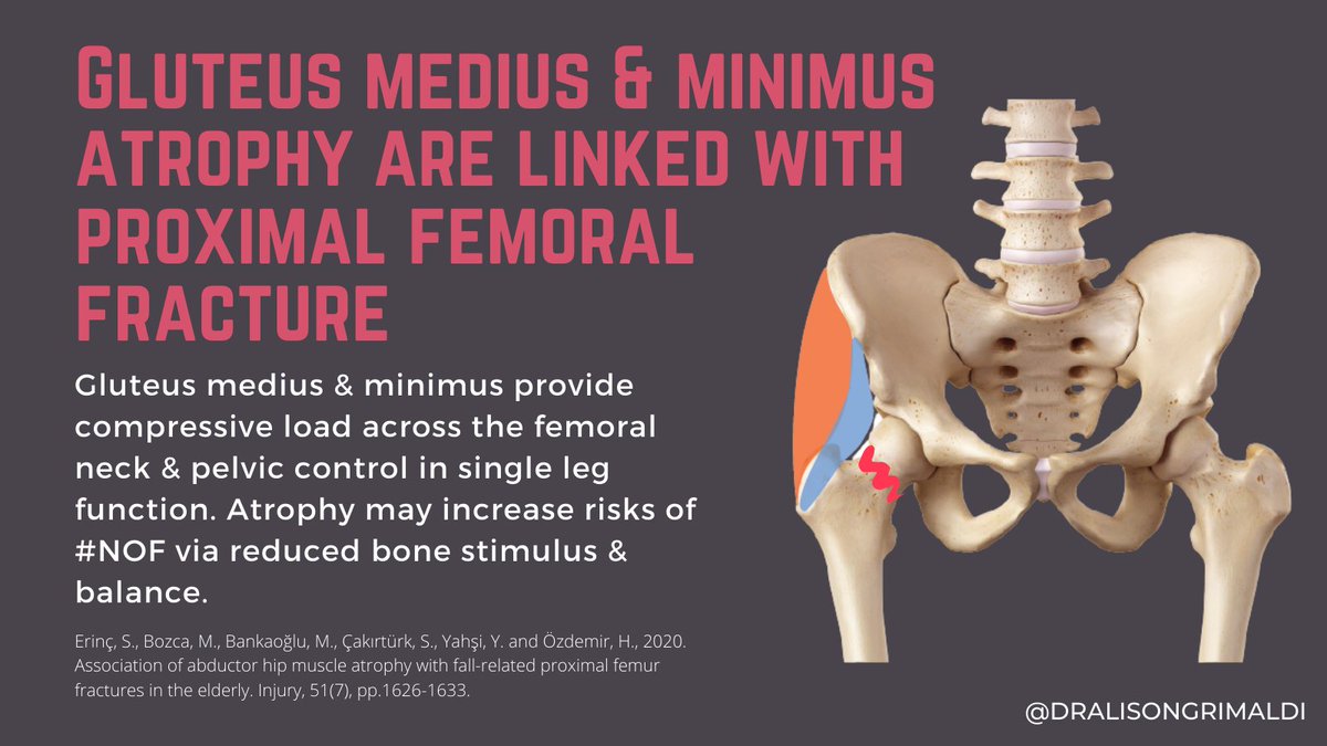 Hip abductor function is so important for older people, particularly with reducing falls risk. The unhappy triad of low bone density, abductor weakness/atrophy and poor balance is something we can target with abductor training and loading.

#hipphysio #physio #hipmobility