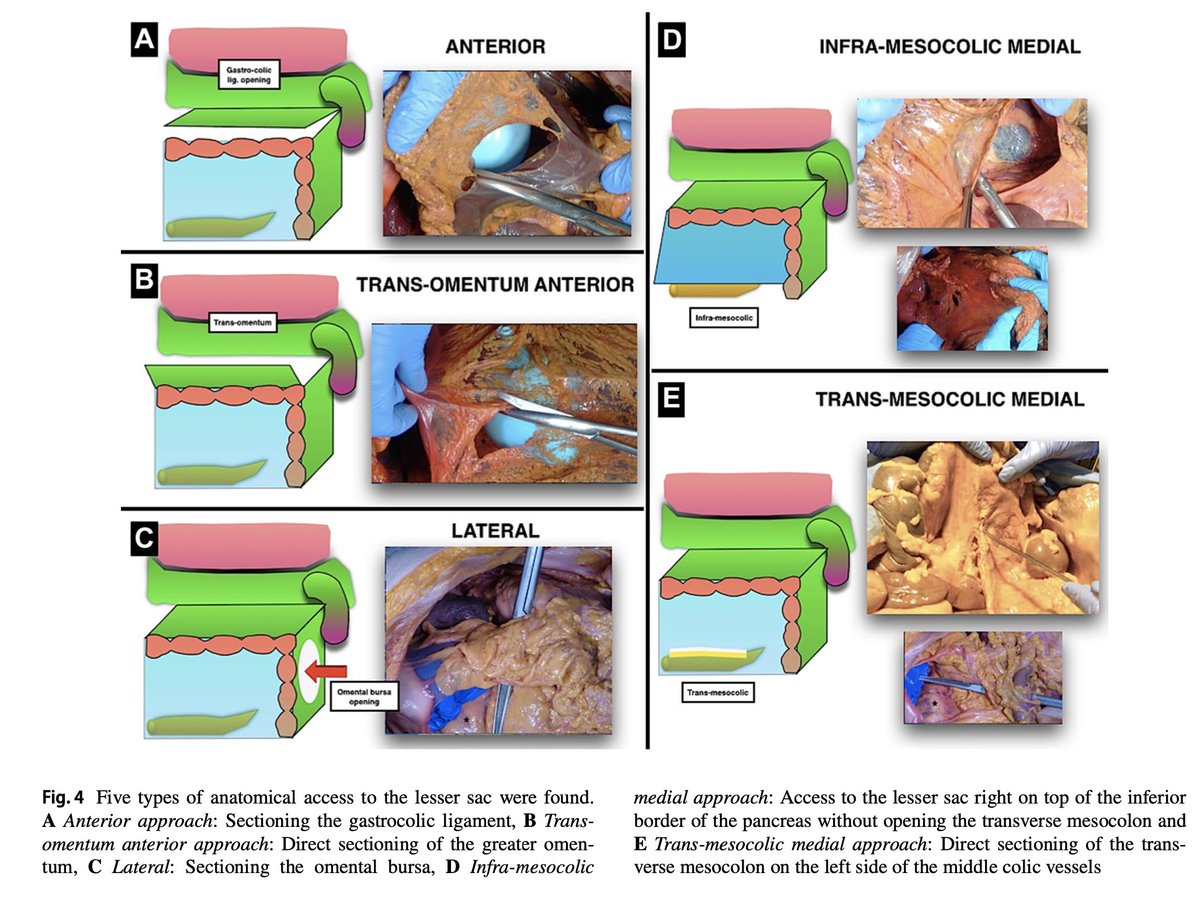 Five acces methods to the splenic flexure. Great job📚👨🏻‍💻