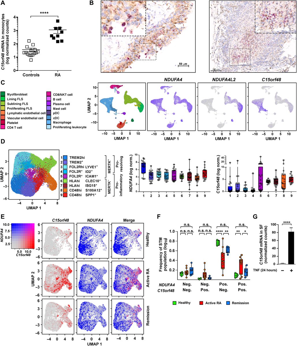 Our @racegbn collaboration with Andy Clark and @SallyAClayton identified that RA proinflammatory MerTKneg synovial tissue macrophage (STM) express C15orf48 protein, whereas NDUFA4 is expressed by resolving MerTKpos STM in joint health and remission of RA.