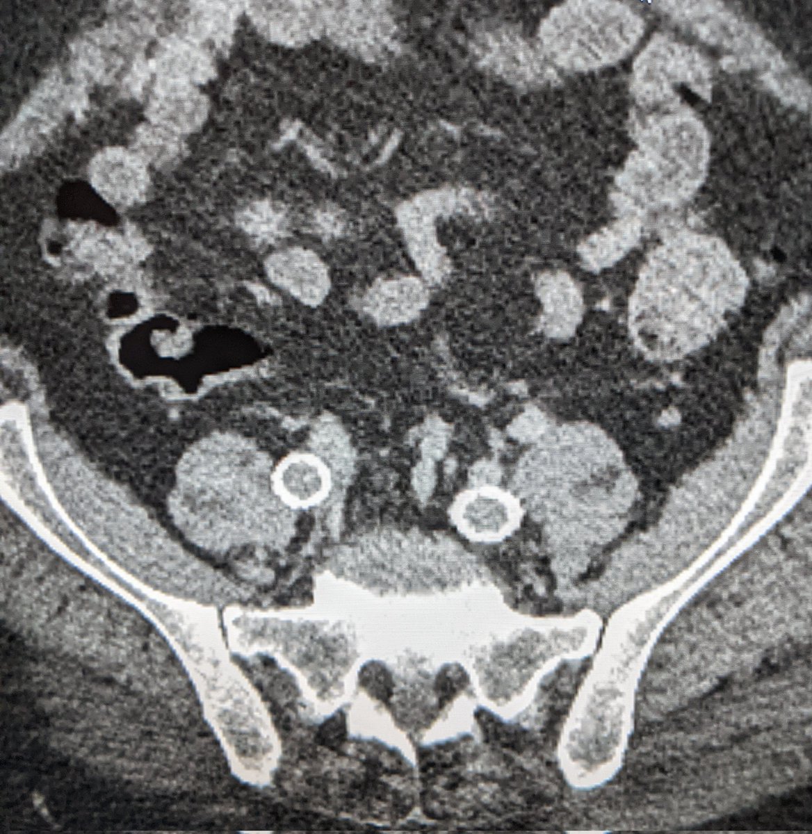 Mark Lessne, MD (@lessnevir) on Twitter photo This #IVCFilter is definitely on š
naughty list!
Thru & thru iliac artery penetration w chronic IVC occlusion
1. #FilterOut (can be done safely)
2. Recan w parallel stents
Pt thrilled at follow up: can walk w/o pain and swelling way down
#IRad <a href="/SIRspecialists/">Society of Interventional Radiology</a> <a href="/VascularSVS/">Vascular SVS</a> This #IVCFilter is definitely on š
naughty list!
Thru & thru iliac artery penetration w chronic IVC occlusion
1. #FilterOut (can be done safely)
2. Recan w parallel stents
Pt thrilled at follow up: can walk w/o pain and swelling way down
#IRad <a href="/SIRspecialists/">Society of Interventional Radiology</a> <a href="/VascularSVS/">Vascular SVS</a>