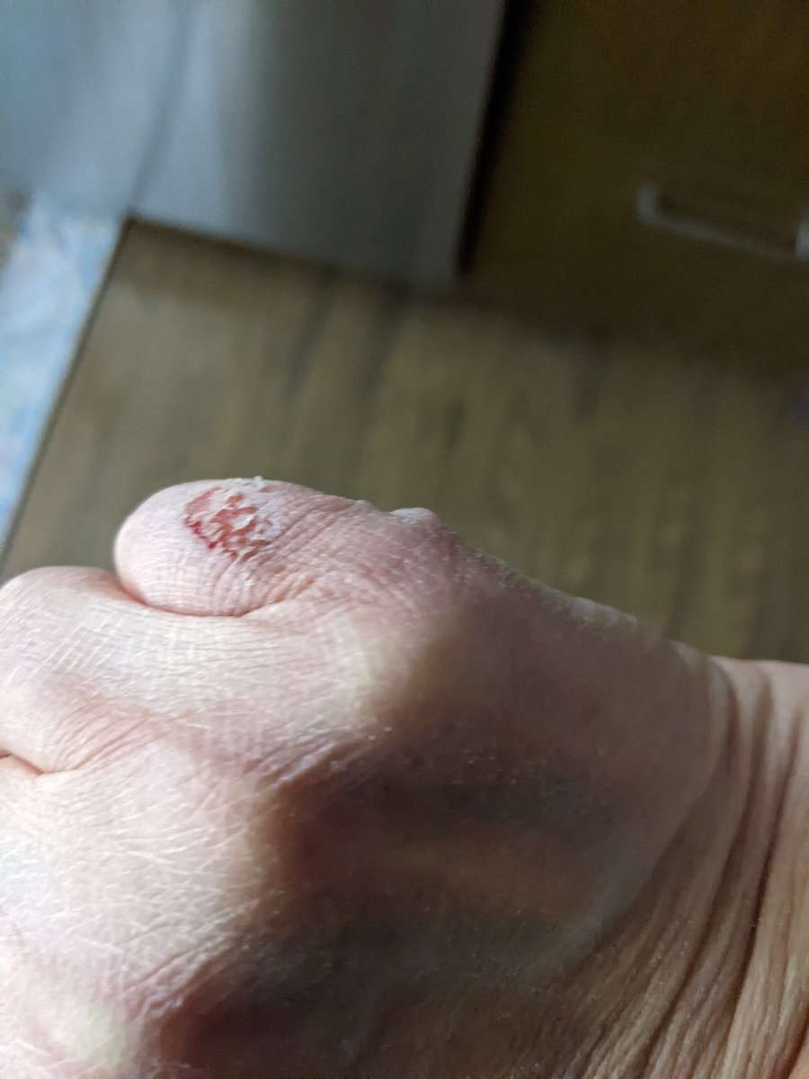 CalgaryBluesky's tweet photo. I have a hypothetical/imaginary (is that clear enough that it's not real ๐) $100 for the person who can guess how I did this to my hand?
No wait, if someone guesses, or close to how I did it, I'll donate $100 to @OxfordHouseAB https://t.co/raNWJm1a2H