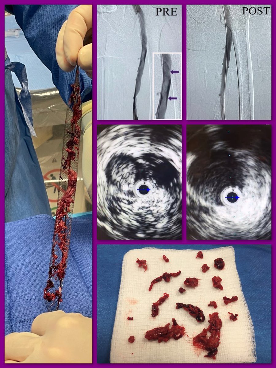 Kevin Herman (@airsllp) on Twitter photo <a href="/InariMedical/">Inari, now part of Stryker</a> <a href="/GeorgiaRooney11/">Georgia Rooney</a> <a href="/JRUNMD/">John Rundback, MD</a> Nice IVUS, fluoro and gross specimens correlation // more disease centrally as well <a href="/InariMedical/">Inari, now part of Stryker</a> <a href="/GeorgiaRooney11/">Georgia Rooney</a> <a href="/JRUNMD/">John Rundback, MD</a> Nice IVUS, fluoro and gross specimens correlation // more disease centrally as well