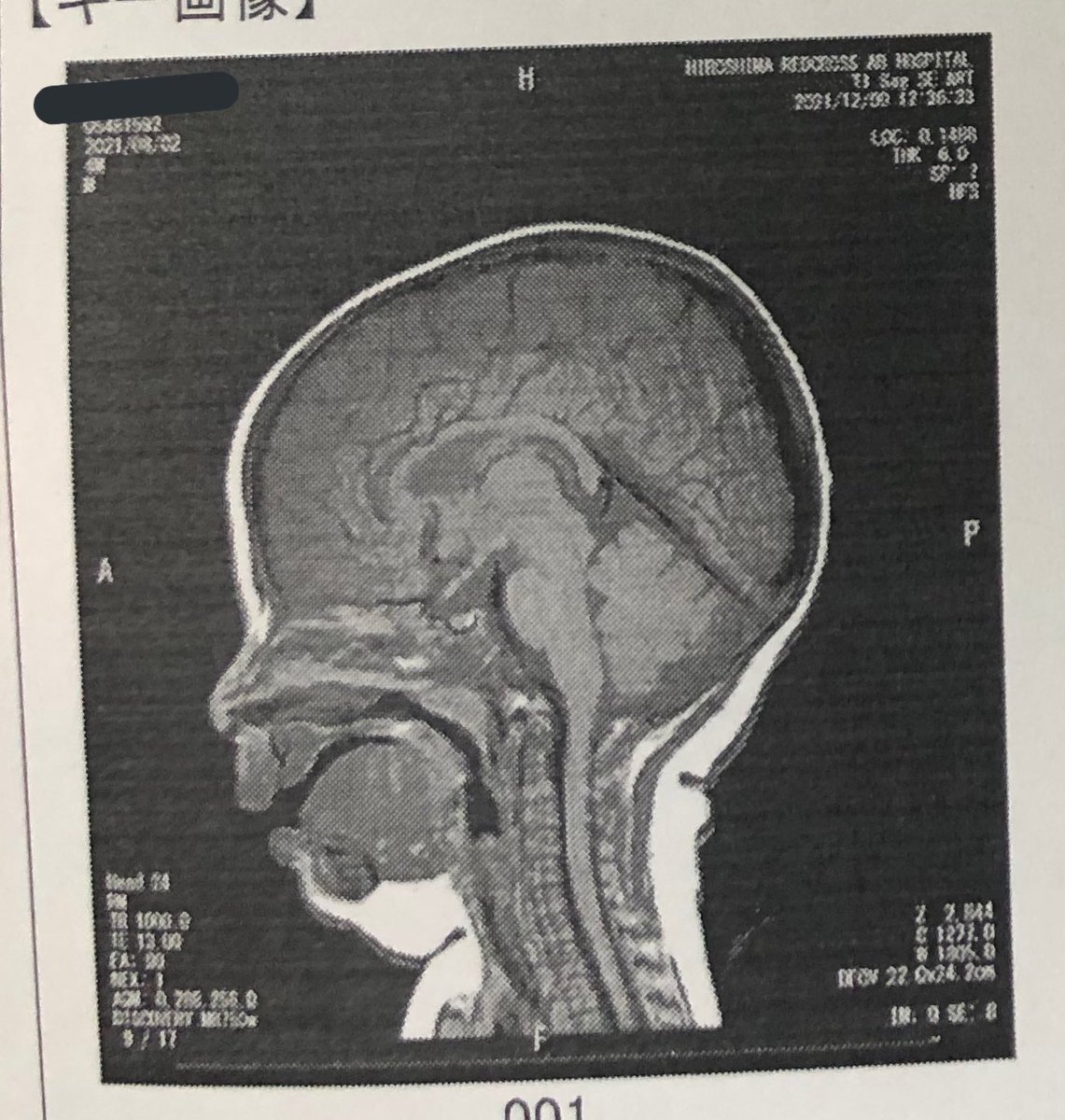 いろいろあって赤子MRIしました。脳に異常は無いけどアゴの肉が思ってた倍ということがわかりました。 