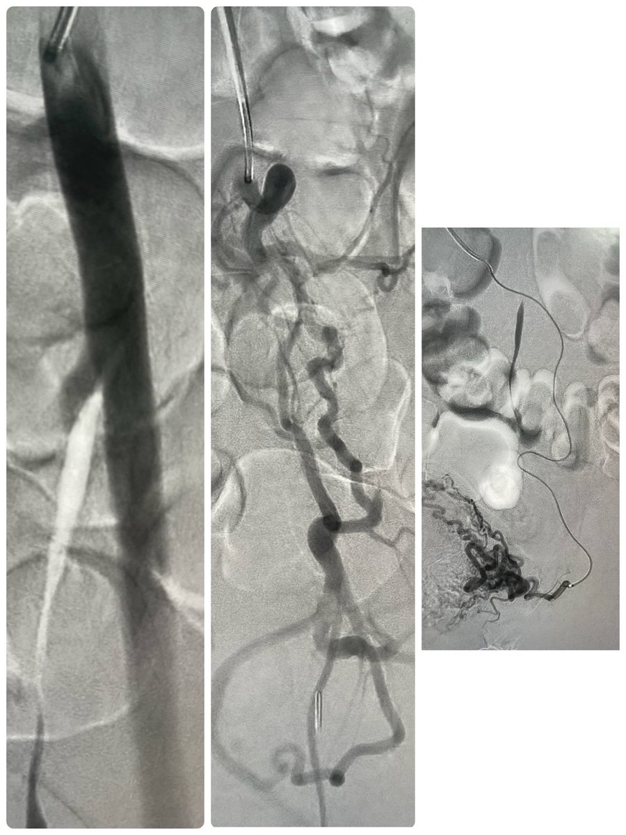 Left internal iliac artery ligated from previous surgery, via collaterals, left uterine artery selected 
برغم أنّ شريان الحوض الداخلي مربوط وعن طريق شرايين فرعيه أمكن الوصول إلى شريان الرحم الأيسر خلال قسطرة الأورام الليفيه