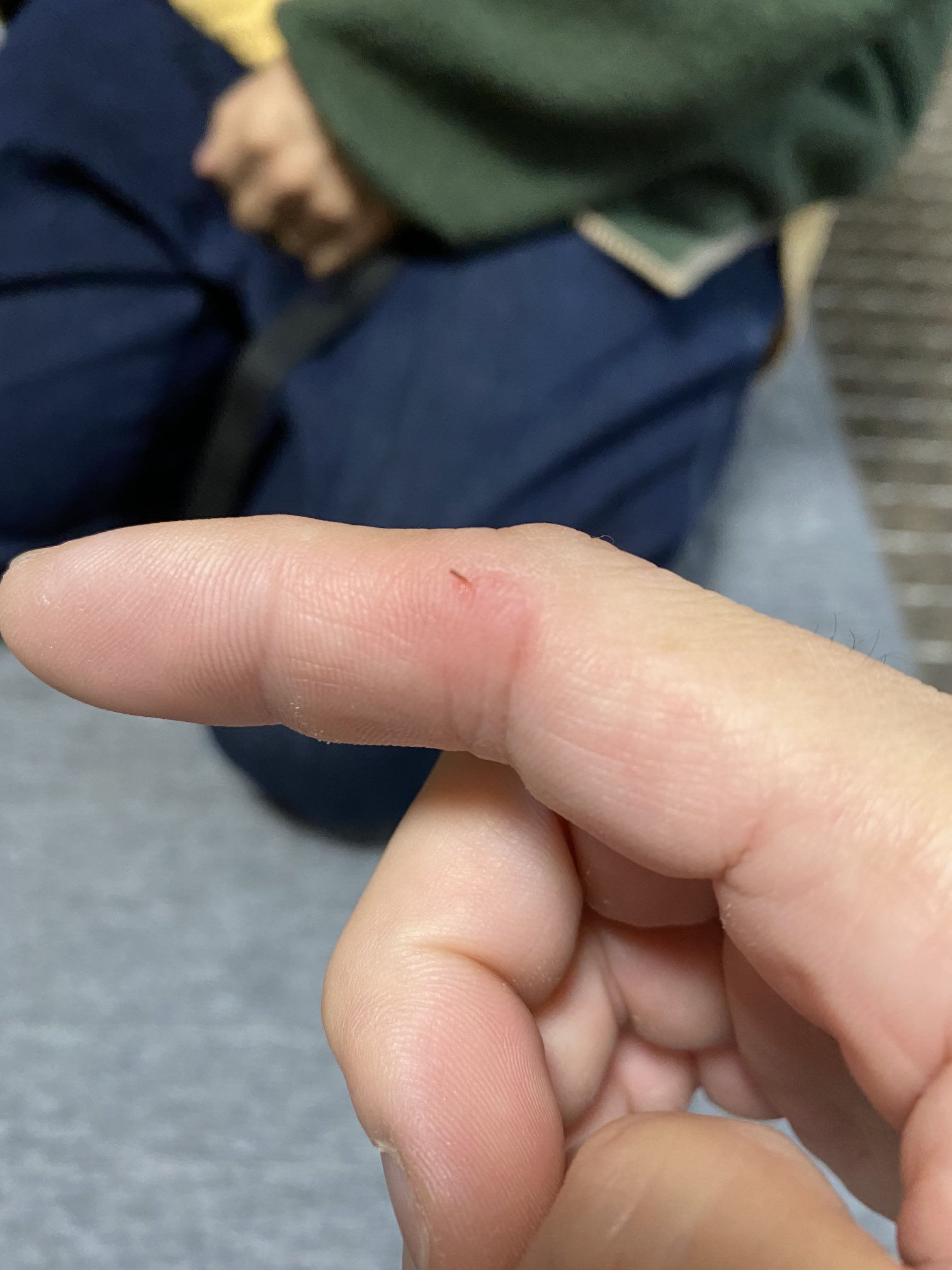 藤田大輔 サボテンならぬパキポディウムの棘が刺さる 自宅で雨ざらしにしてたゲアイーが 位置ずらしたら倒れそうになったので手を出すとプスっと 長い棘は抜いたけれど 折れたものが残っていた ちょっと触れると鈍痛でとても不快 1人では対応できず