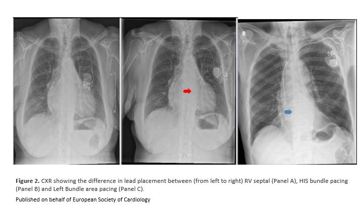 ESC_Journals's tweet photo. #CRT is effective in #HFrEF &amp; electrical dissynchrony.  #Biventricular pacing is not always feasible. #ConductionSystem pacing  is emerging to enhance physiological pacing. @Mokhtar90481252 reviews recent #CRT advances in #CVPracticeJournal https://t.co/C1aB7Mb4EO

@StefanoNistri https://t.co/ZW96LnFZJ0