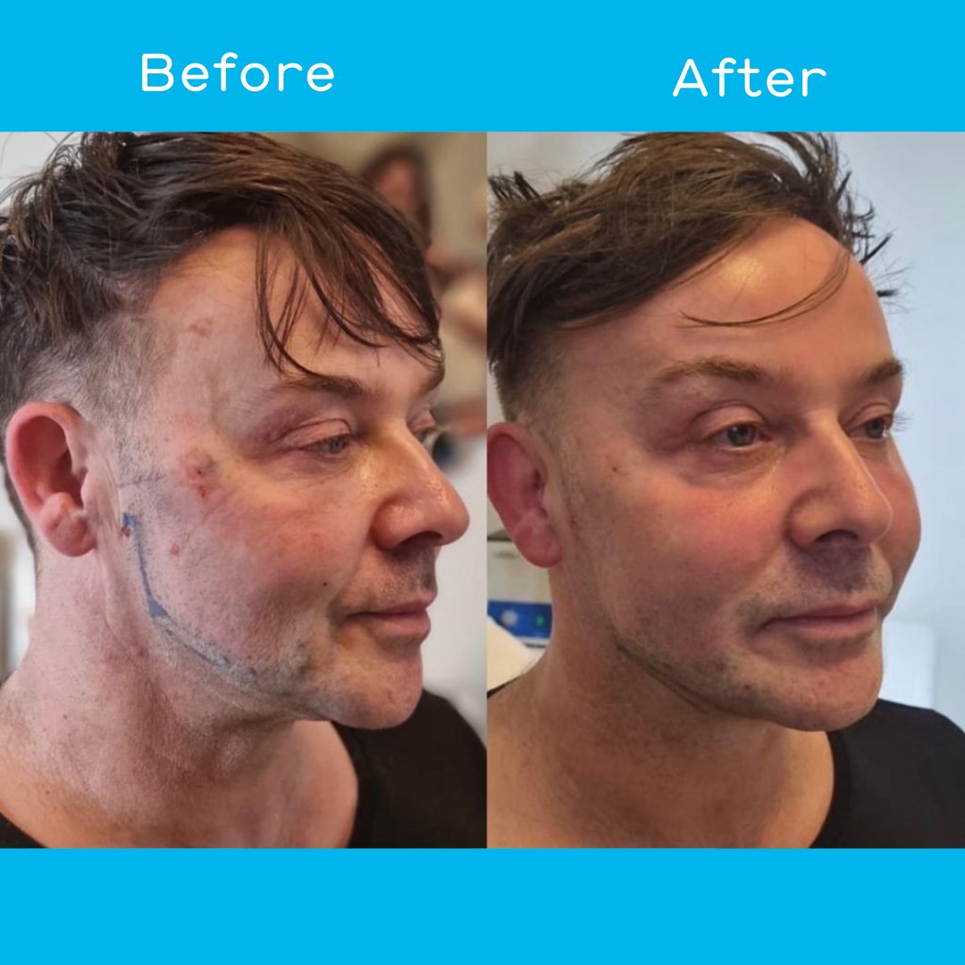 CromaPharmaUk's tweet photo. Introducing our latest innovation in thread lifting, the NEW Anchor Plus - just look at the amazing results!
Benefits include
• Skin rejuvenation and tissue elevation
• Skin reinforcement and scaffolding
• Tightening 
Please contact your local representative.
@drritapoddar https://t.co/xdgJ5EvJHQ