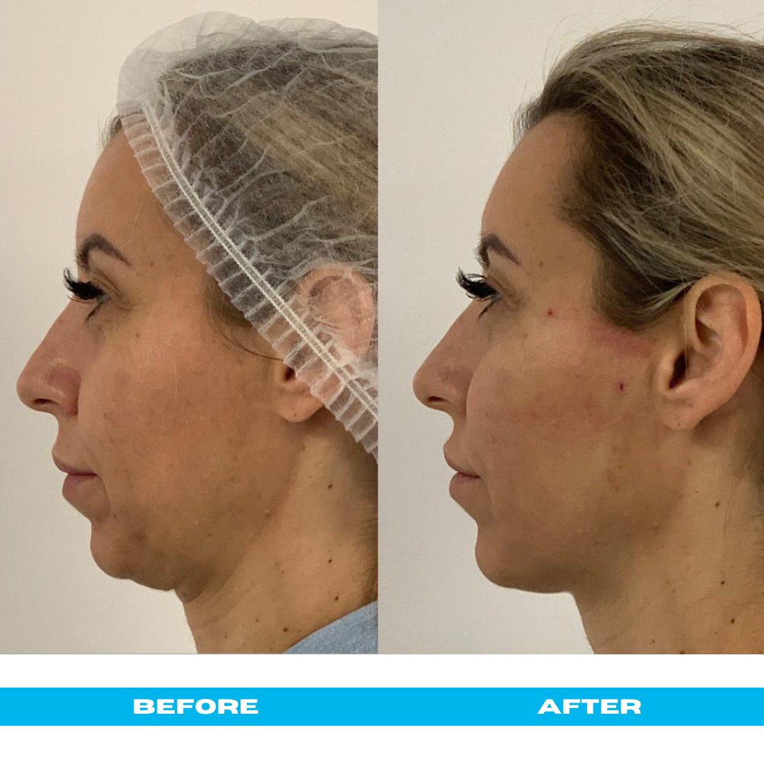 CromaPharmaUk's tweet photo. Introducing our latest innovation in thread lifting, the NEW Anchor Plus - just look at the amazing results!
Benefits include
• Skin rejuvenation and tissue elevation
• Skin reinforcement and scaffolding
• Tightening 
Please contact your local representative.
@drritapoddar https://t.co/xdgJ5EvJHQ