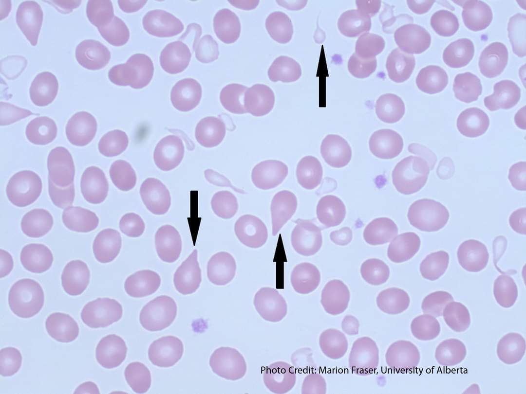 8Oquz7wXRmQ5aaT's tweet photo. Teardrop 💧 cell (dacrocytes) 
Red blood cell
They are frequently associated with infiltration of the bone marrow by fibrosis, granulomatous inflammation, or hematopoietic or metastatic neoplasms . also be seen in patient with splenic abnormalities. Vitamin B12 deficiency https://t.co/eeSKTBvzHp