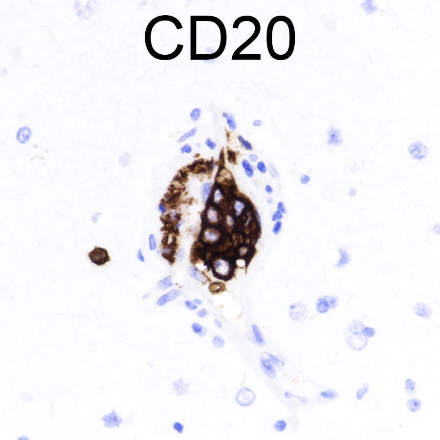 Biopsy of the right frontal lobe in a 72 year-old man. What's the most likely diagnosis? #pathology #neuropath #PathTwitter