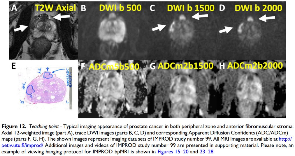 jambor_ivan's tweet photo. *** Finally out ***
Pictorial review on #bpMRI in men with a clinical suspicion of #PCa
https://t.co/ytf2seBoK6
- 30 figures
- 10s of videos and extra material in supporting material @ https://t.co/ngnsHfFL4Z
- access to complete imaging, lab & histo datasets of 161+338 pts https://t.co/qaUWD6IZ9d