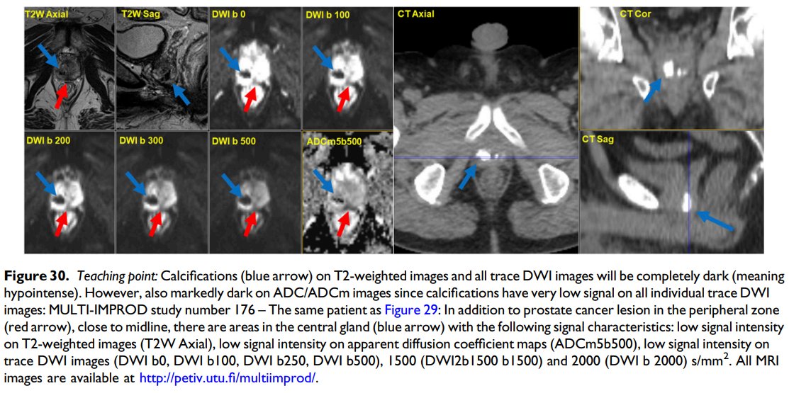 jambor_ivan's tweet photo. *** Finally out ***
Pictorial review on #bpMRI in men with a clinical suspicion of #PCa
https://t.co/ytf2seBoK6
- 30 figures
- 10s of videos and extra material in supporting material @ https://t.co/ngnsHfFL4Z
- access to complete imaging, lab & histo datasets of 161+338 pts https://t.co/qaUWD6IZ9d
