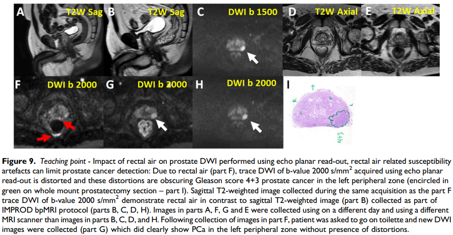 jambor_ivan's tweet photo. *** Finally out ***
Pictorial review on #bpMRI in men with a clinical suspicion of #PCa
https://t.co/ytf2seBoK6
- 30 figures
- 10s of videos and extra material in supporting material @ https://t.co/ngnsHfFL4Z
- access to complete imaging, lab & histo datasets of 161+338 pts https://t.co/qaUWD6IZ9d