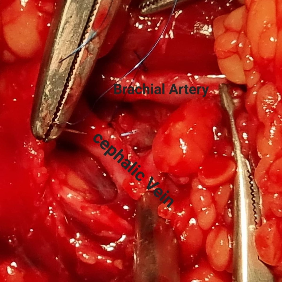 RahmaniaCentre's tweet photo. We succesfully repaired a case of Stab( Knife) wound with complete cut of Brachial Artery and Partially cut Cephalic Vein. https://t.co/5iXPLALSgi