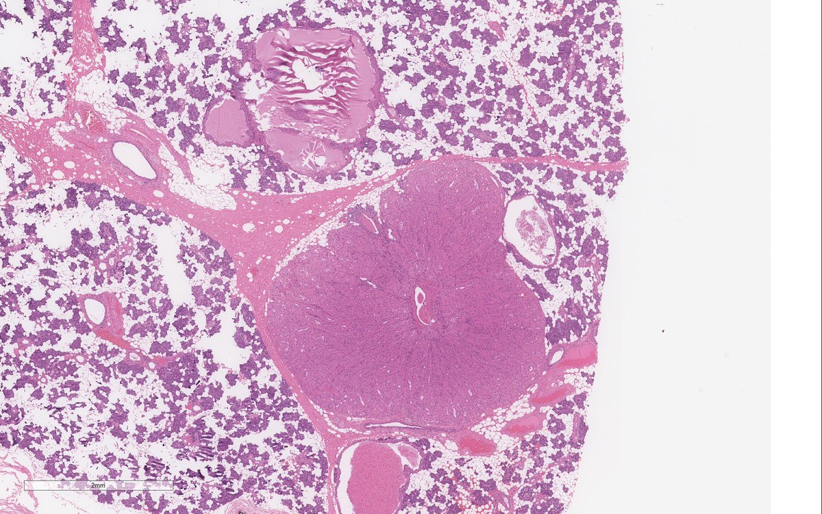 WeinrebIlan's tweet photo. Multifocal oncocytoma/oncocytosis of parotid. 

🔹multiple nodules, some circumscribed and some not. 

🔹some can be clear cell rich. 

🔹p63 should show an incomplete outer layer around the nests. 

But wait…aren’t these supposed to be golden brown grossly? See final pic. https://t.co/NL0lfbfwFg