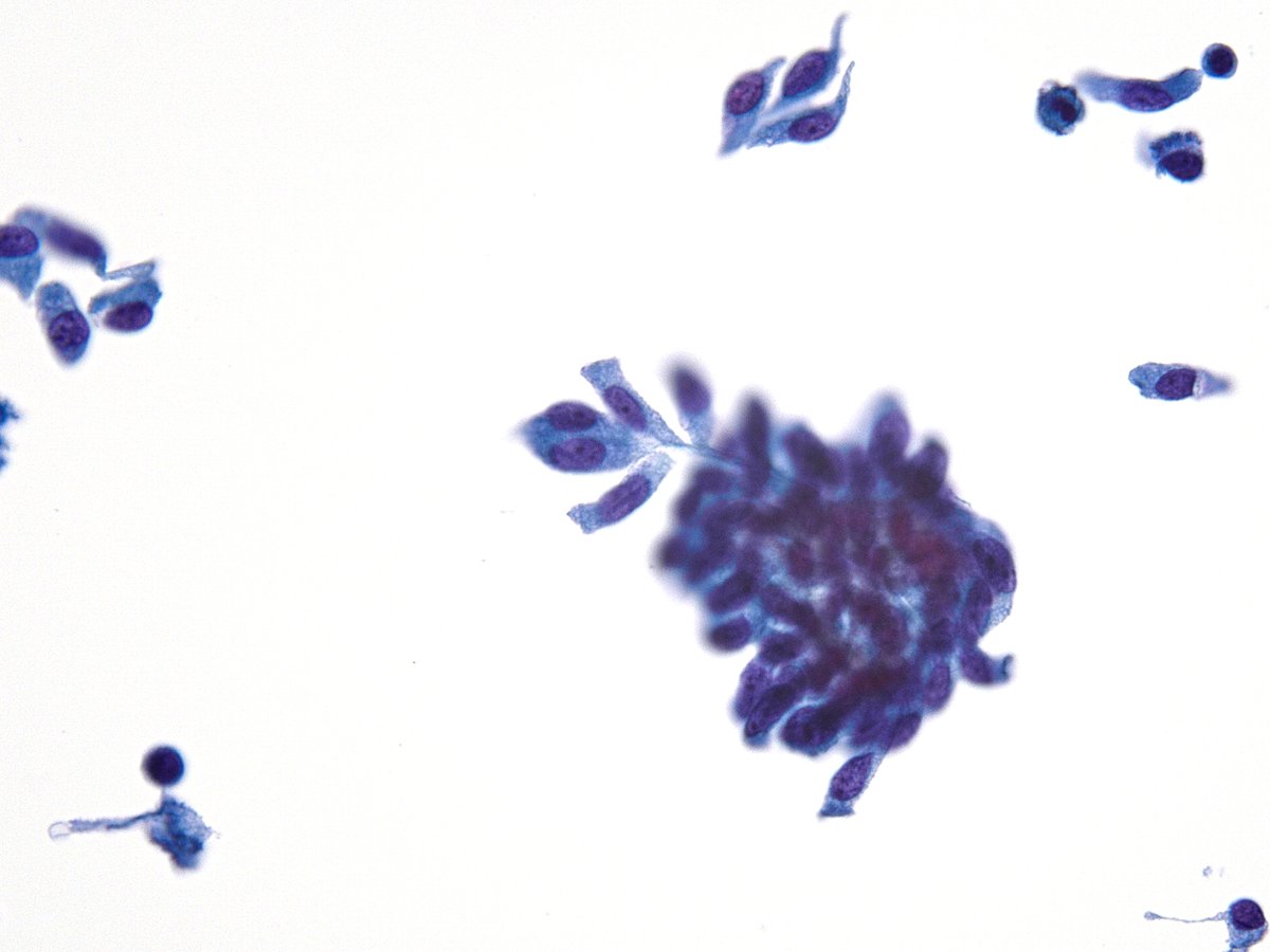 sza_jhcyto's tweet photo. "Tall, Taller, Tallest" -  Papillary Thyroid Carcinoma. https://t.co/pmXzL2hSYV