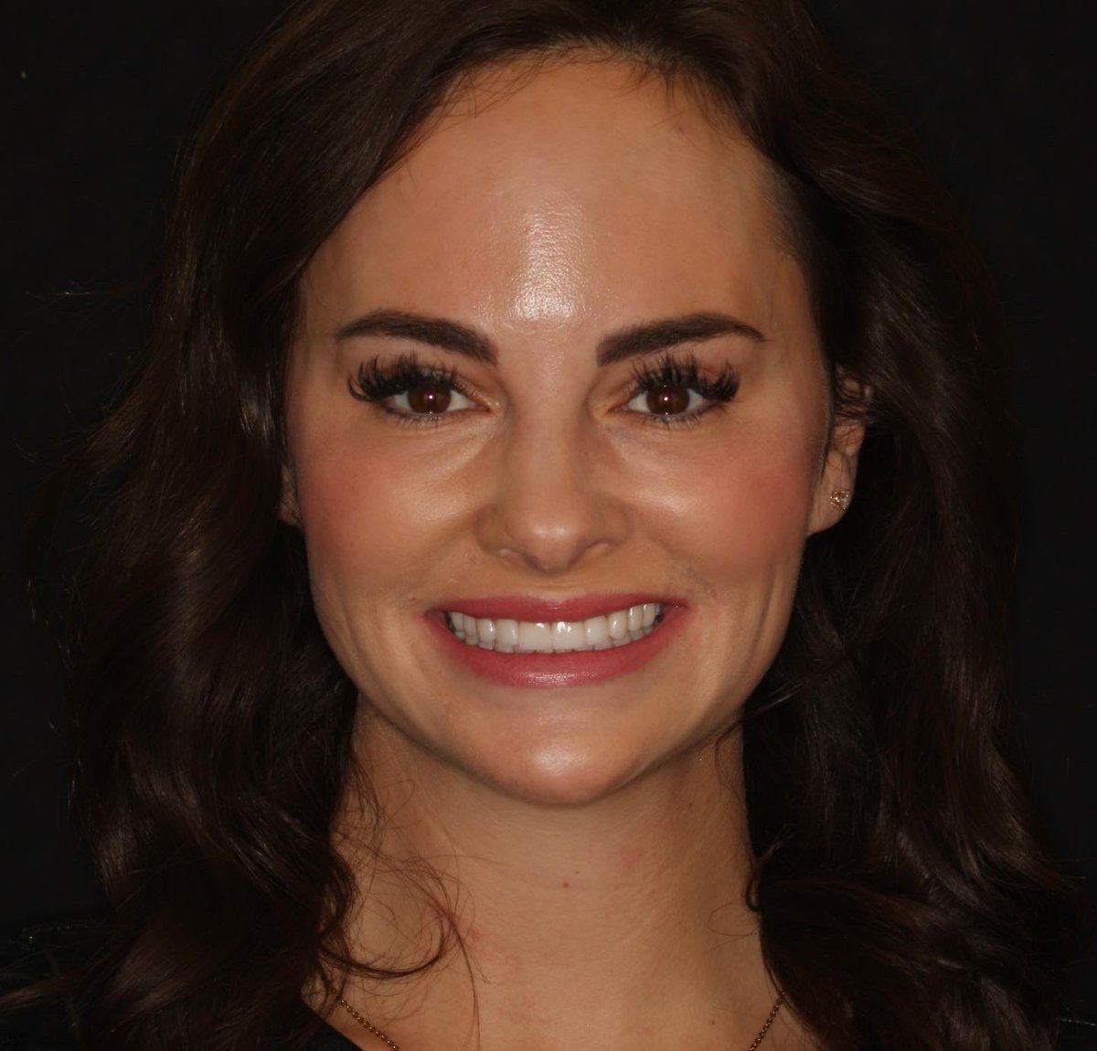 AmarilloSmiles's tweet photo. New smile by Dr. Miller. 10 upper veneers
#amarillocosmeticdentist #smiledesign #aesthetics https://t.co/8Dks92EuPp