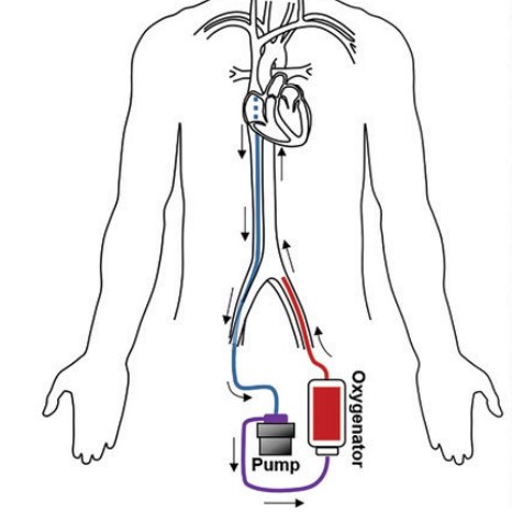 StanfordRadCVI's tweet image. Hot off the press🔥on @RadioGraphics 
📰CT Angiography of Venoarterial Extracorporeal Membrane Oxygenation by @JodyShenMD and @justintsemd

🔍common and unusual VA-ECMO–related artifacts
🔍strategies for optimizing CTA image acquisition

👀Read more here: bit.ly/3EJjnpm