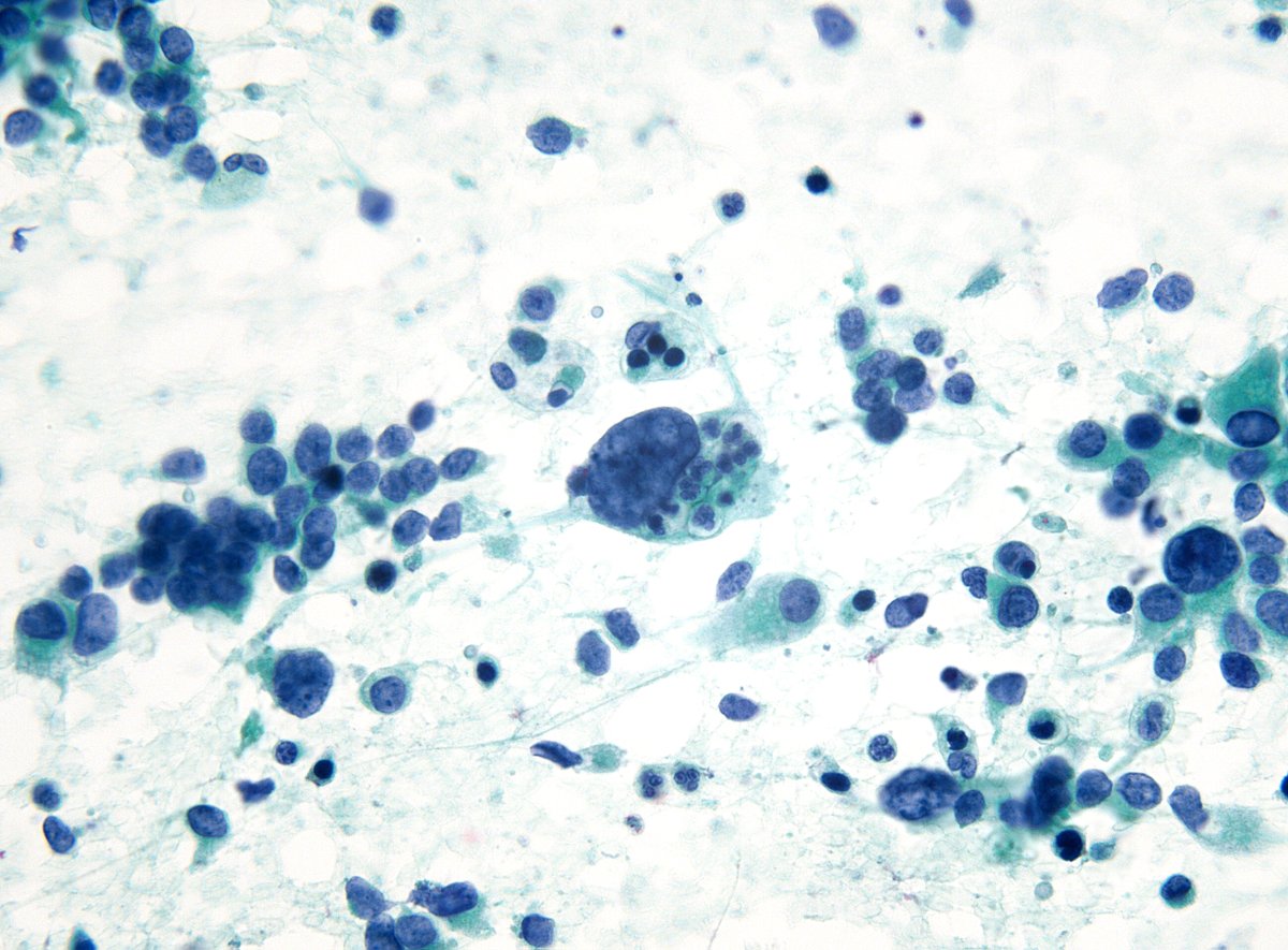 sza_jhcyto's tweet photo. "Emperipolesis" is derived from Greek (em – inside; peri – around; polemai – wander about). Here is an uncommon occurrence in a renal pelvic tumor - "High-grade Urothelial Carcinoma", (FNA). @chriszioga @cjvand https://t.co/OG5SjcwkSQ