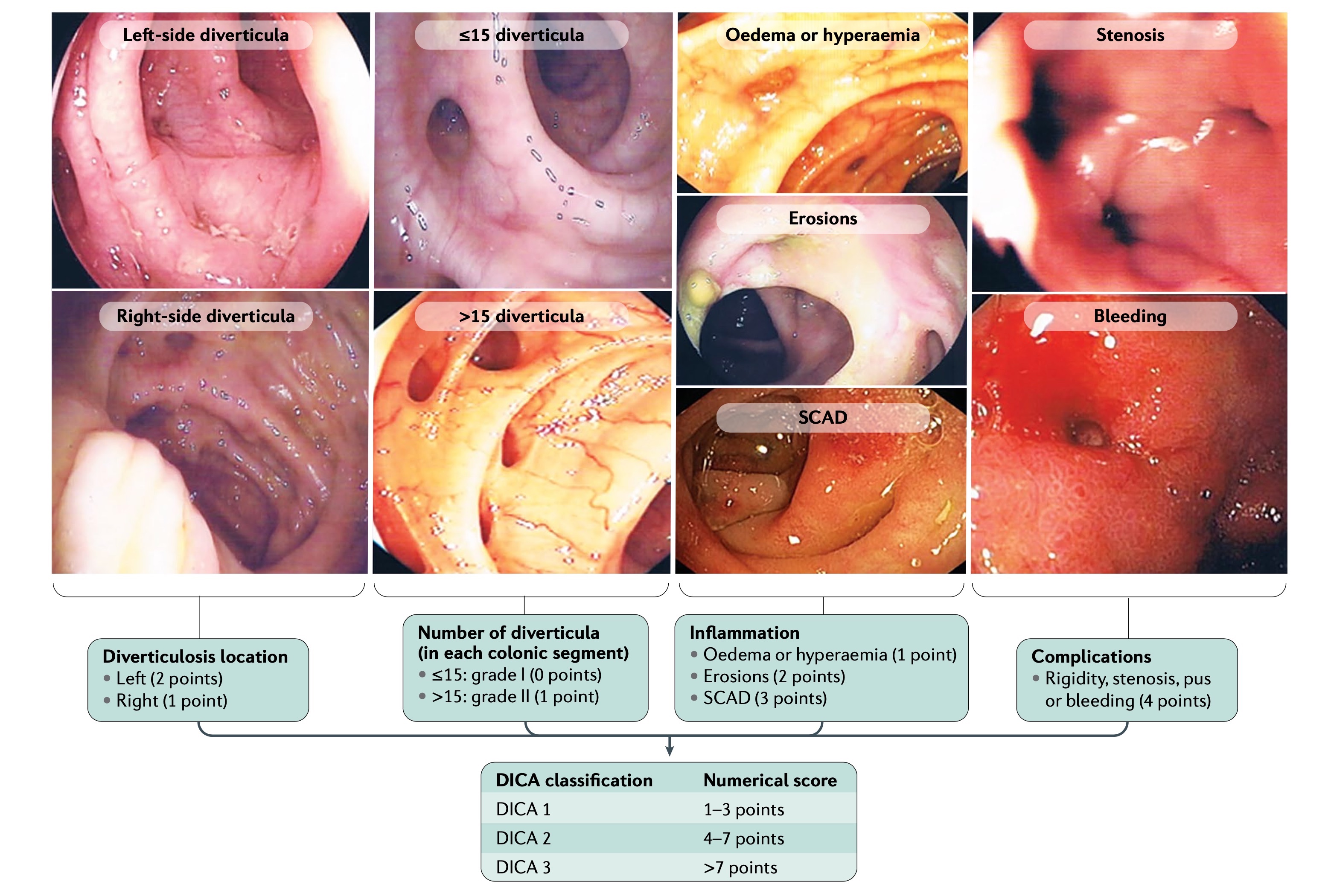 Antiinflamatorio para diverticulitis