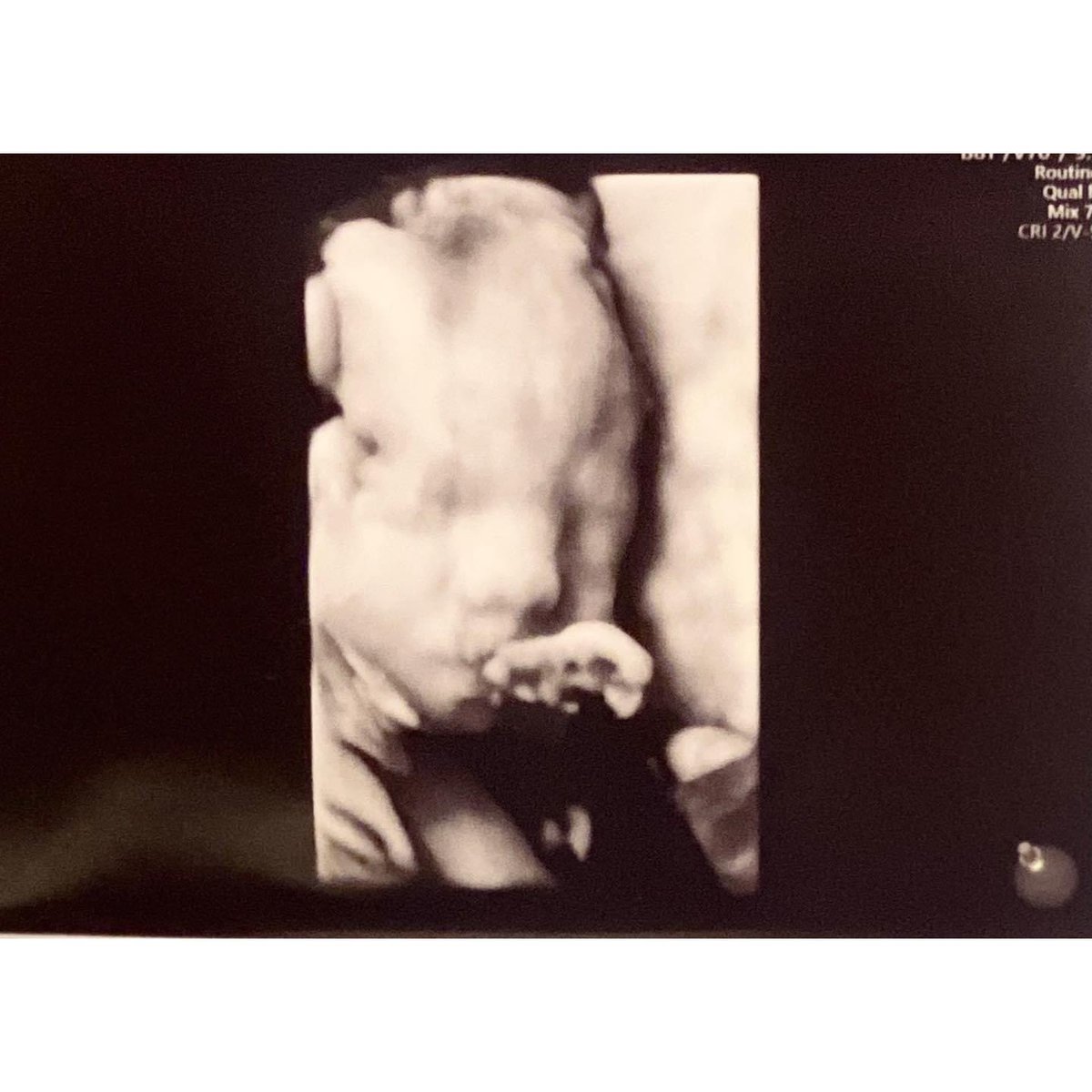 An update on Baby Straz that my wife wrote up, she has a way with words. 

We appreciate all the prayers, love, and support we have received. There is power in prayer, and my wife and I truly feel every prayer. ❤️💙