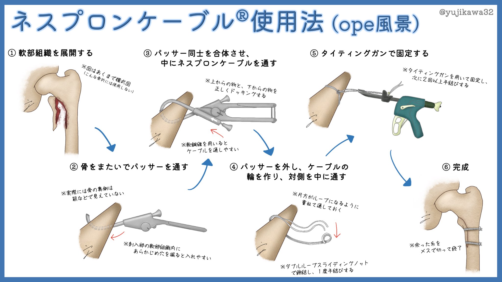 インプラント周囲骨折を極める