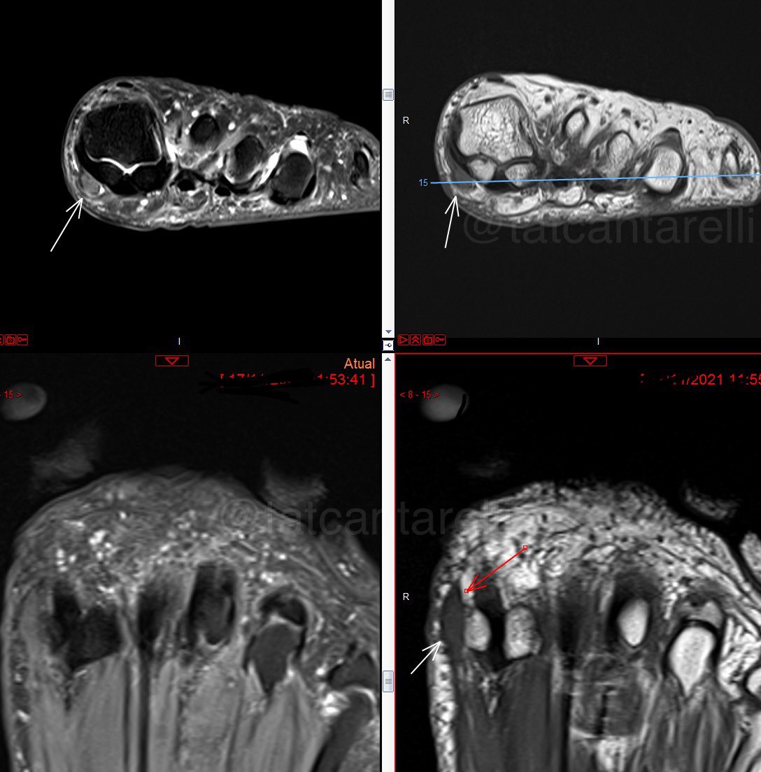 tatcantarelli's tweet photo. “Hallux numbness” 🦶
* Joplin neuroma *
- perineural fibrosis of the medial plantar digital proper nerve
- imaging features similar to any other neuroma (Morton or traumatic)
#MSKRad #radiology #orthotwitter #radiologia #podiatry #radres https://t.co/XKLE1Z1QOw