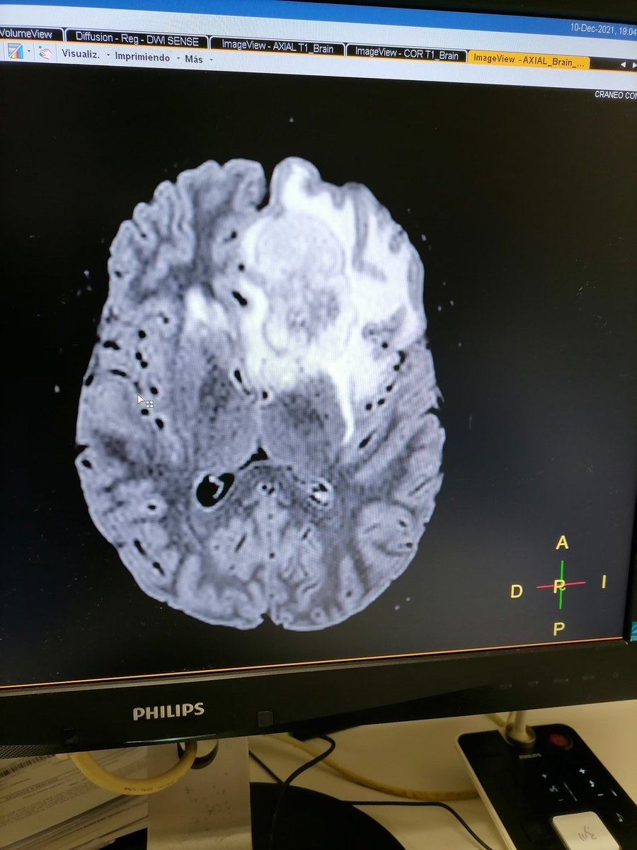 Tenecteplasa's tweet photo. Masculino de 17 años. Cefalea ocasional de 3 meses de evolución. Súbitamente cambio en la personalidad y deterioro neurológico. Así los casos en el CMN LA RAZA. https://t.co/q6Kr6tbUy7