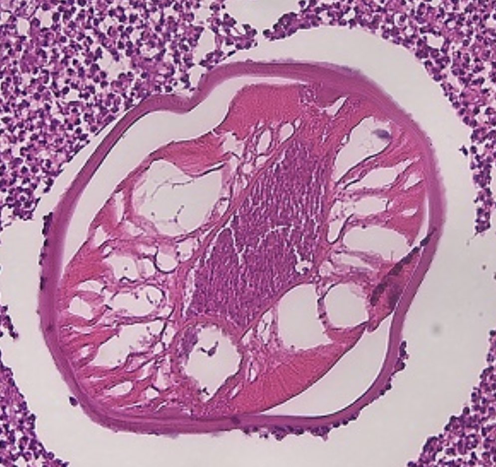 #idboardreview Pt from Srilanka w/ non-tender enlarging cheek nodule. During surgery: a wriggling worm extracted: microscopic exam thick external cuticula w/ longitudinal ridges (microruffling of surface), cogwheel appearance on transverse section. Dx? #idtwitter #meded