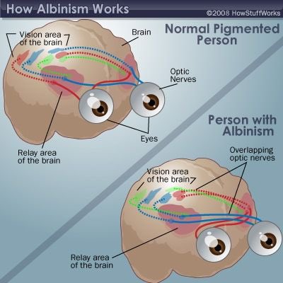 Heolddu_ALN's tweet image. Nystagmus and ocular albinism - sharing information to help raise awareness of visual impairment youtu.be/CjqHVTJfmG4 check out this video for a better understanding 👁 #visualimpairment #sencom #ocularalbinism #nystagmus