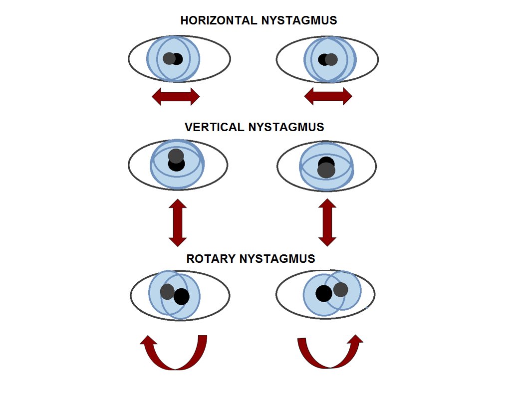 Heolddu_ALN's tweet image. Nystagmus and ocular albinism - sharing information to help raise awareness of visual impairment youtu.be/CjqHVTJfmG4 check out this video for a better understanding 👁 #visualimpairment #sencom #ocularalbinism #nystagmus