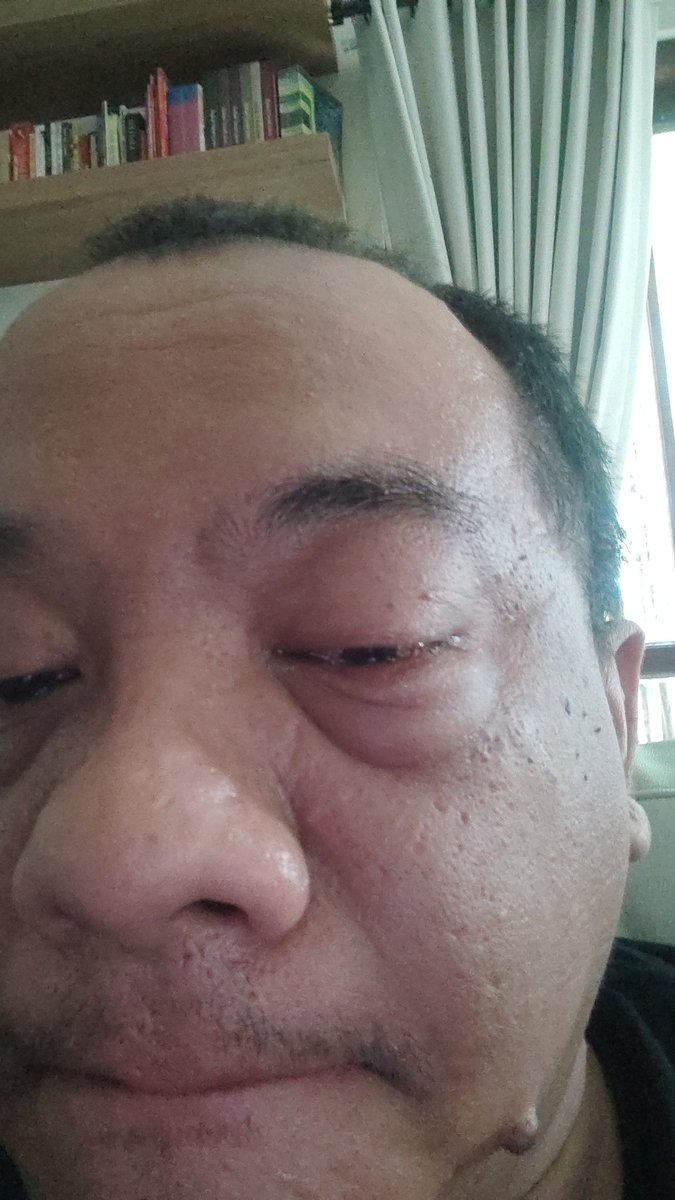 ForzaRino's tweet photo. Duh infeksi kelopak mata https://t.co/AcduxuItSB
