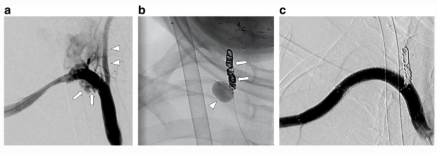 cvirendo's tweet photo. This #retrospective study 🔍 assesses the short-term efficacy + safety of emergency endovascular treatment #EVT using a Viabahn #stentgraft for upper + lower extremity arterial bleeding #ULEAB
To read more about the authors' findings, click here:
https://t.co/psfYyQrZaX https://t.co/lFiVwxgktG