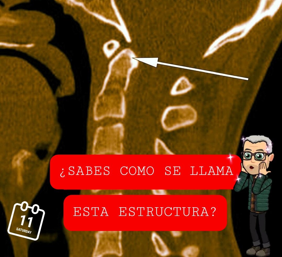 SanitariaR's tweet photo. P. Qué estructura señala la flecha?
🔁 la respuesta
#anatomiaradioloxica #calendariodeadviento
#TSIDMN https://t.co/BfCc8QEWwa