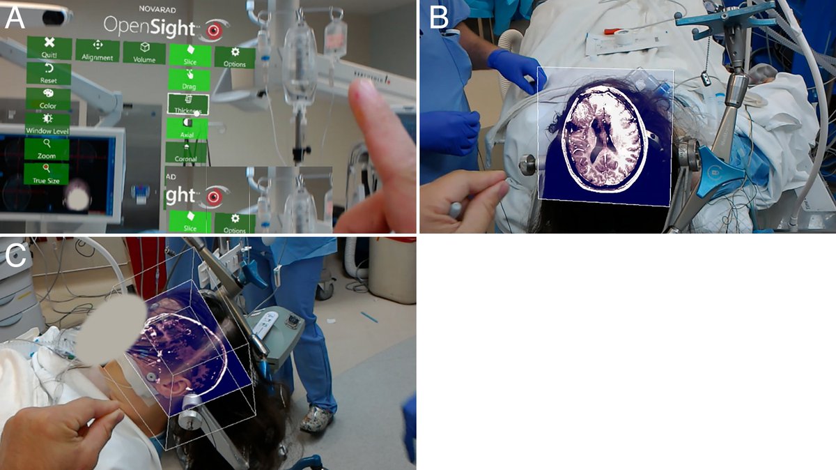 TheJNS's tweet image. #NeurosurgicalFocus Augmented reality head-mounted display–based incision planning in cranial neurosurgery: a prospective pilot study

thejns.org/focus/view/jou…