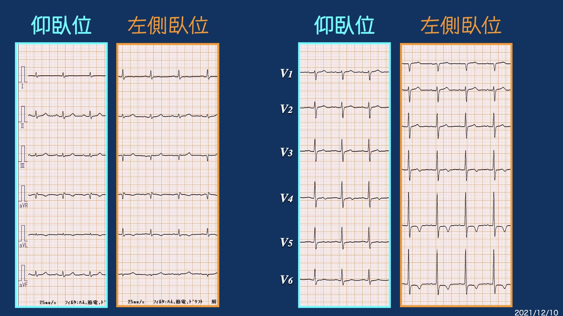 N. Tsukishima EP大学心電図検定学部試験対策科担任 в X: „(仰臥 N. Tsukishima EP大学心電図検定学部試験対策科担任 в X: „(仰臥